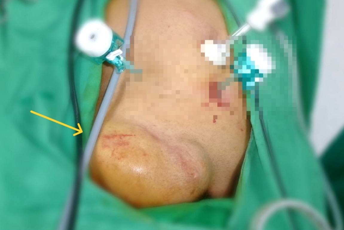 近八旬老翁下面「鼓一包」腹痛求醫
