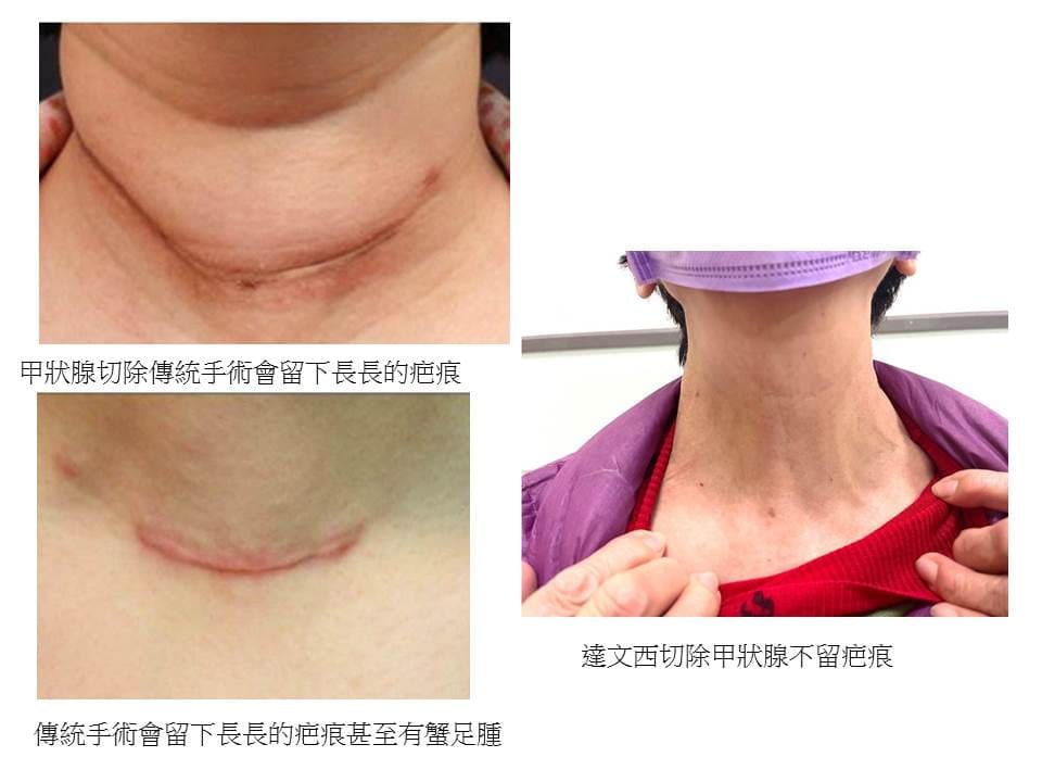 刪疤(三月八日)婦女節 摘下女王的項鍊甲狀腺切除 嘉基達文西 不「瘤」痕跡