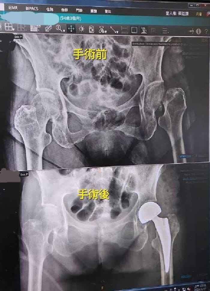 助高齡近百歲阿嬤 勇腳爬五樓 嘉基新引進專用腳架