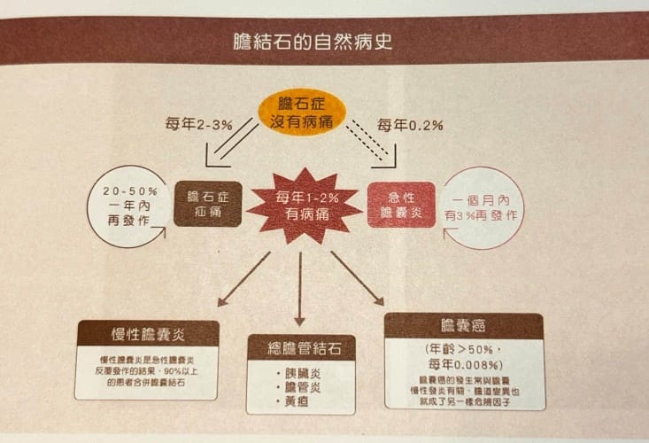膽結石真會引發膽囊癌！