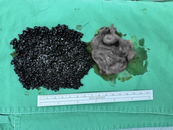 輕熟女大啖火鍋後喊腹痛