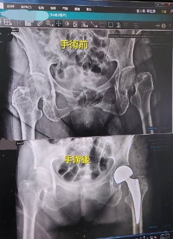 助高齡近百歲阿嬤 勇腳爬五樓 嘉基新引進專用腳架